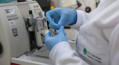 SUS inclui nova terapia para pacientes adultos com leucemia mieloide